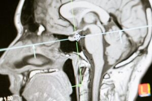 מהי האדרה ב-MRI מוח פרופ’ חן הופמן מסביר